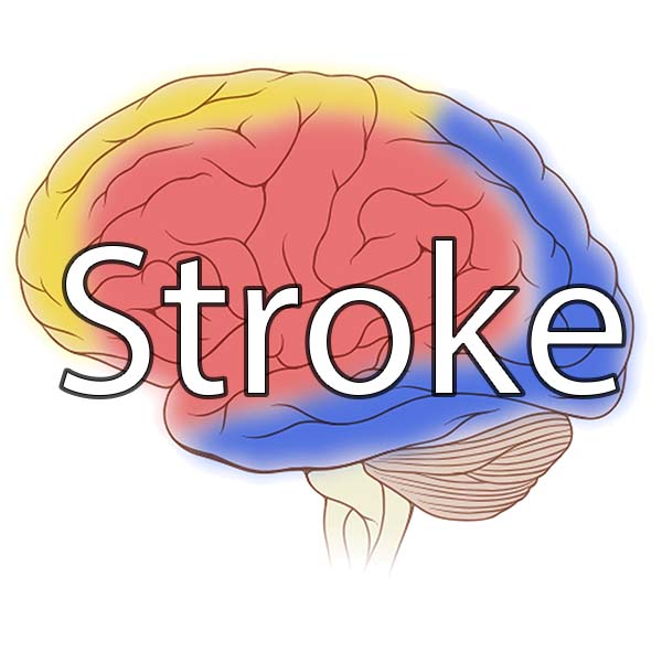 Stroke Medicine Notes: Classification and Types of Stroke with MCQs